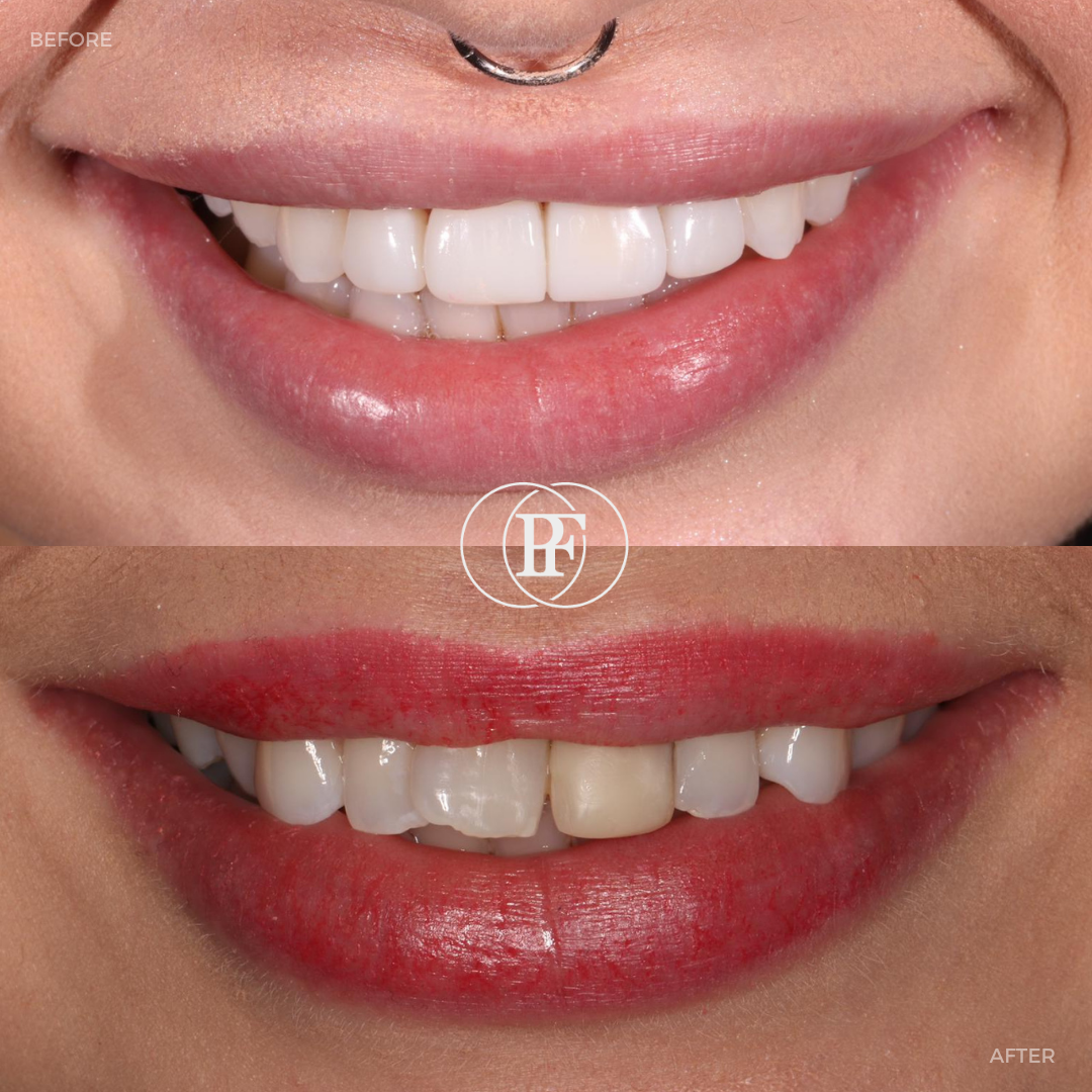 Before and after treatment at Oris Dental Implants Dundee