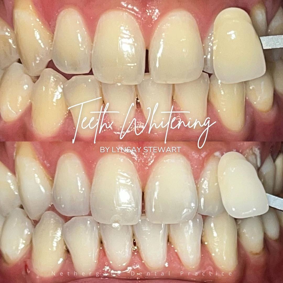 Oris Dental & Implant Studio Tooth whitening