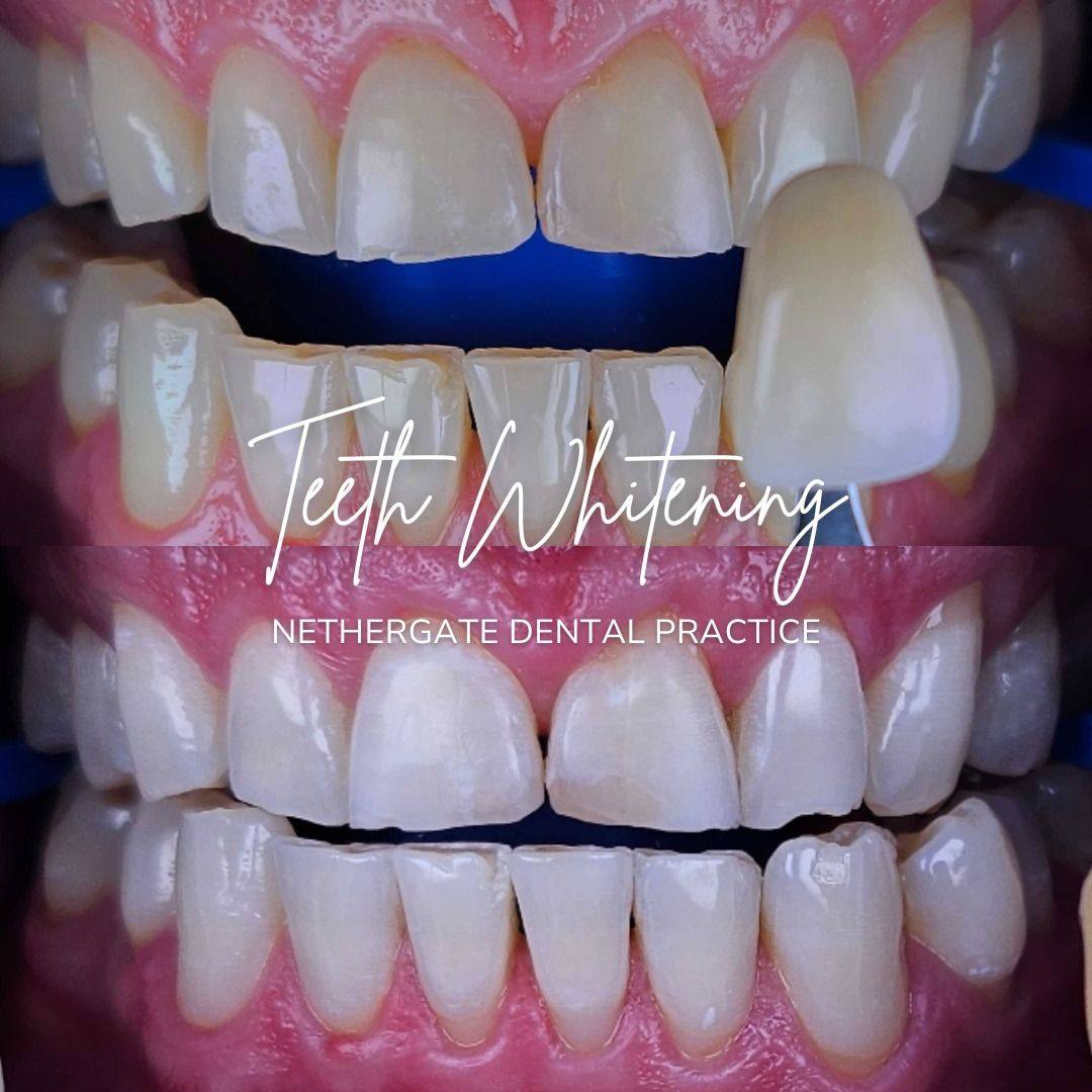 Oris Dental & Implant Studio Tooth whitening